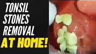 Tonsil Stones Removal Causes and Treatment [upl. by Sivam835]