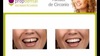 Zirconio  Protesis de circonio  Dientes 100 naturales [upl. by Allesig51]