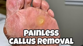 CALLUS REMOVAL FROM FEET PAINLESS PROCEDURE [upl. by Aivilo]