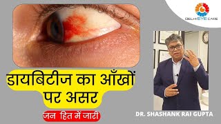 डायबिटीज का आँखों पर असर  Dr Shashank Rai Gupta Retina Specialist at Delhi Eye Care [upl. by Esilenna]