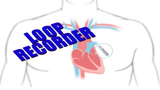 Loop Recorder Monitoring your heart nonsurgical procedure [upl. by Nagar]