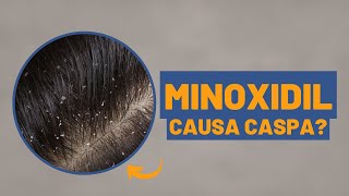 Minoxidil causa caspa  Dra Débora Cadore  Dermatologista Florianópolis [upl. by Berneta692]