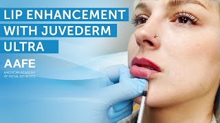 Adding More Lip Volume with Juvederm Ultra  AAFE [upl. by Care]