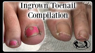 Satisfying Ingrown Toenail Pedicure Compilation [upl. by Elttil315]