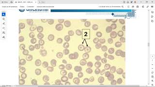 ETAPA 1 As Neoplasias Mieloproliferativas constituem um grupo de doenças clonais de células progenit [upl. by Eugnimod]