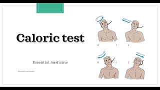 Caloric test Essential medicine [upl. by Liza]