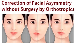 Correction of Facial Asymmetry Without Oral Surgery Using Orthotropics Method By Dr Mike Mew [upl. by Barlow]