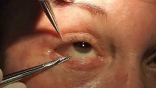 Management of PostBlepharoplasty Chemosis [upl. by Ahsekar781]