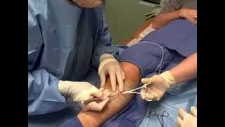 Ambulatory Phlebectomy Vein Removal  Skinovative and Center for Venous Disease [upl. by Aitital679]