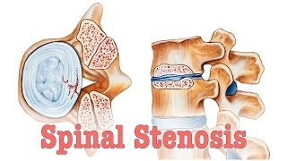 Spinal Stenosis  Surgery vs Chiropractic Care [upl. by Einal670]