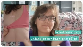 Update Neurofibromatosis back operation Neurofibromatosis afteroperation postoperation [upl. by Sivrup]