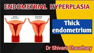 Endometrial hyperplasia  Thick endometrium heavybleeding uterus [upl. by Yael]