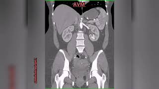 AVMArteriovenous malformations in left kidney [upl. by Korff362]