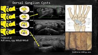 Dorsal Wrist with Dr Benjamin Nelson  AMSSM Sports Ultrasound Case Presentation [upl. by Fabrianna]