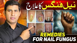 Cure Nail Fungus At Home in 7 Days│How to Get rid of Nail Fungus│Toenail Fungus│Nail Fungus Causes [upl. by Ybreh]