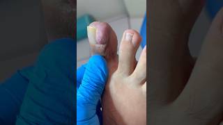 Uña encarnada con fibroma [upl. by Tracie]