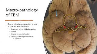 Paediatric Series Tuberculous Meningitis [upl. by Stralka]