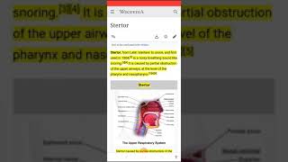 Stertor Noisy breathing sound like snoring [upl. by Adnar292]