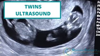 TAKE A PEEK Twins at 11 Weeks [upl. by Steinway]