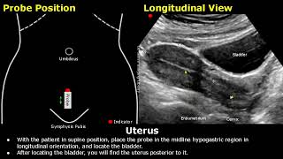 Uterus amp Ovaries Ultrasound Probe Positioning  Transducer Placement  Gynecological USG Scanning [upl. by Michaele]