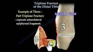 Triplane Fracture Of The Distal Tibia  Everything You Need To Know  Dr Nabil Ebraheim [upl. by Rube]