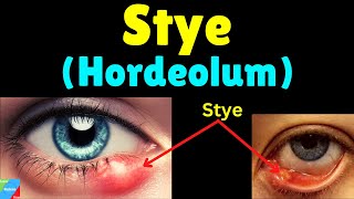 Stye Hordeolum Symptoms Causes Treatment amp Prevention – Sty [upl. by Montfort]