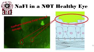 Sodium Fluorescein Dye and Staining in Eyecare Part I [upl. by Cod]