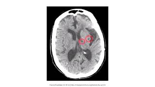 Cerebrovascular Disease for the USMLE Step 1 [upl. by Ataner559]