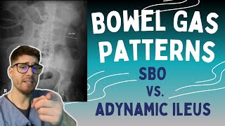 SBO vs Adynamic Ileus Learn the 369 rule to read bowel gas patterns on Xrays [upl. by Nomra]