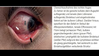 Beidseitige Bindehautentzündung Konjunktivitis im Verlauf einer Affenpockeninfektion [upl. by Nirrad382]