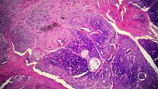 Mucoepidermoid Carcinoma High Grade [upl. by Tris616]