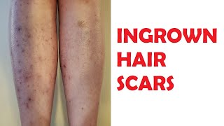 how to get rid of ingrown hair scars on legs [upl. by Karlotta]