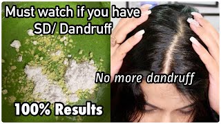 Current Scalp amp Hair Situation  BEST SEBORRHEIC DERMATITIS TREATMENT Best Home Remedy for Dandruff [upl. by Astred]