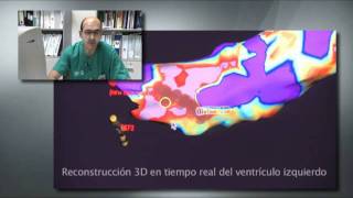 Ablación mediante radiofrecuencia de taquicardia ventricular de origen isquémico [upl. by Blight]