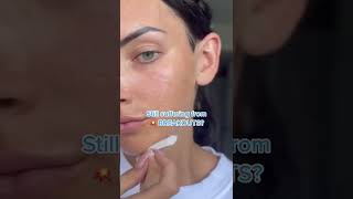 Clear Acne and Prevent New Breakouts │ CeraVe Skincare [upl. by Aihsila]