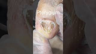 Pterygium of the Toenail [upl. by Atnoed319]