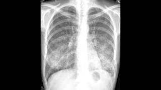 Interstitial Pneumonia Atypical  Organisms amp Characteristics [upl. by Ledeen]