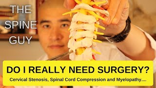 Cervical Stenosis Spinal Cord Compression and Myelopathy DO I REALLY NEED SURGERY [upl. by Millur]