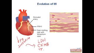 Myocardial infarction evolution pathology [upl. by Latvina]