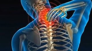 Tratamiento de Radiculopatía Cervical con acupuntura y plantas medicinales [upl. by Ojaras344]