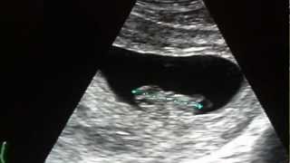 Identical Twins แฝดแท้ Ultrasound อายุ 8 สัปดาห์ 4 วัน [upl. by Philips]