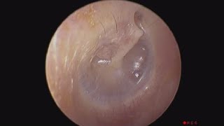 Valsalva Manoeuvre to Normalize Negative Middle Ear Pressure [upl. by Aletse]