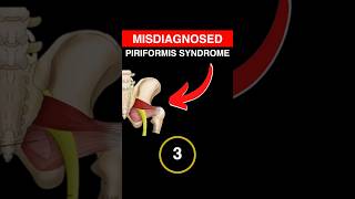 Misdiagnosed Piriformis Syndrome Fixed in Seconds [upl. by Rodie995]