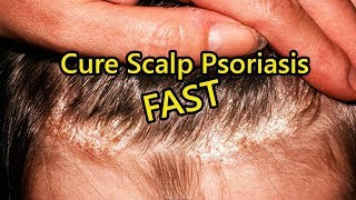 Scalp Psoriasis Home Remedies  How to Cure Scalp Psoriasis FAST [upl. by Giraud]