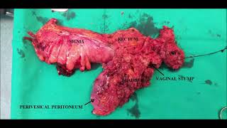 Laparoscopic Total Pelvic Exenteration in patient with endometrial carcinoma relapse [upl. by Strong]