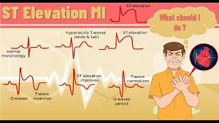 ST elevation myocardial infarction STEMI  ST elevation MI pathophysiology ECG finding and example [upl. by Deron255]