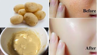 Potato Face Pack For Glowing Skin Pigmentation Acne Scars Clear Skin Beesan face pack [upl. by Idmann]