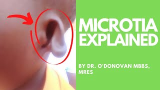 Explaining Microtia an abnormally shaped ear with Dr ODonovan [upl. by Shiller485]