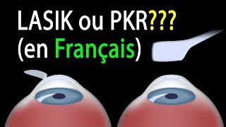 LASIK ou PKR Comparaison des procédures animation [upl. by Letnahs]