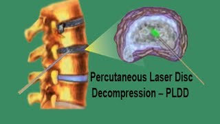 PLDD  Percutaneous Laser Disc Decompression [upl. by Evod]